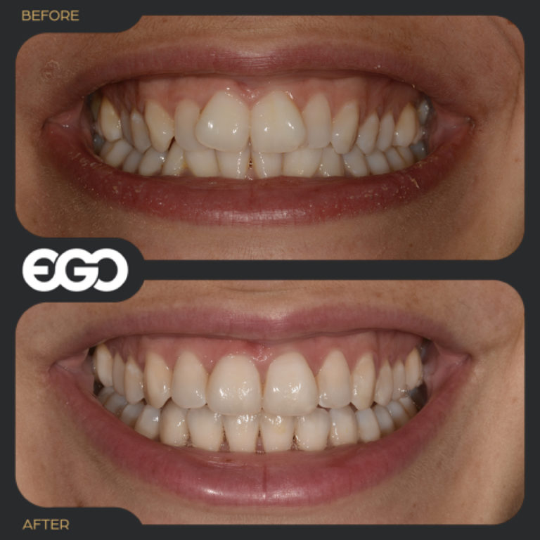 Invisalign® Treatment The Official EGO Dental Clinic Westminster