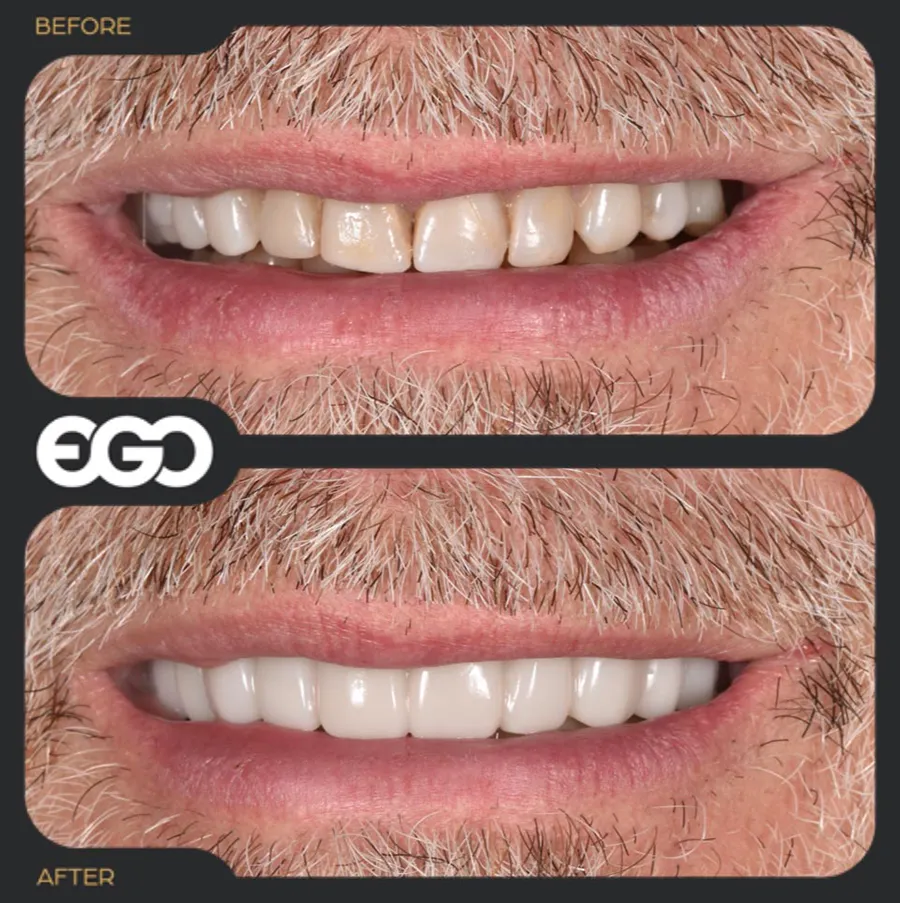 Dental dentures: Before/After 2- EGO dental London