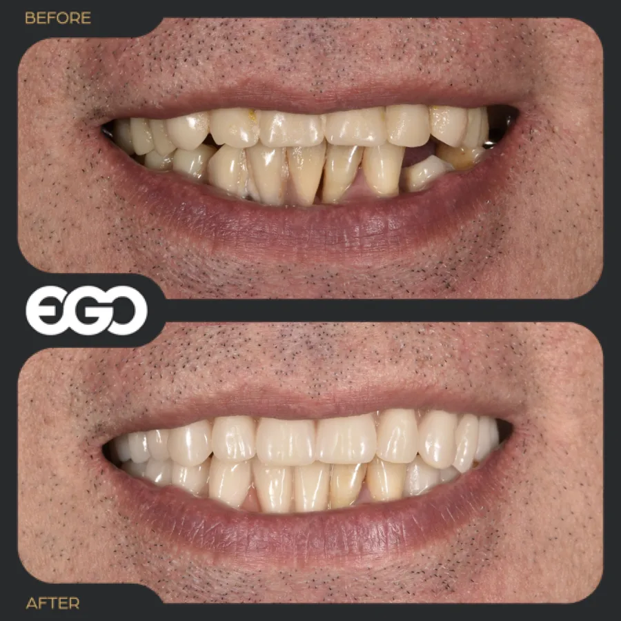 Dental dentures: Before/After 1 - EGO dental London